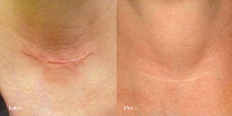 Before & After laser genesis skin therapy - Revive Medical Botox and Laser