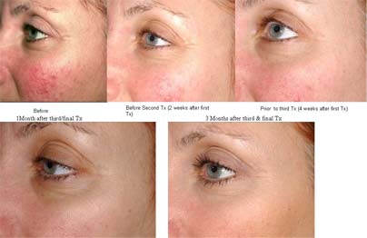 laser genesis work - Revive Medical Botox and Laser