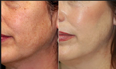 Before & After Limelight - Revive Medical Botox and Laser