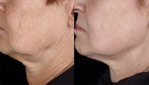 Before & After Titan Skin Tightening - Revive Medical Botox and Laser