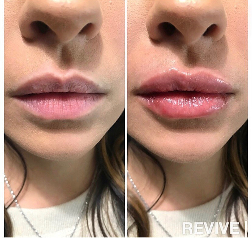 Lip Filler Facts Revive Medical Philadelphia